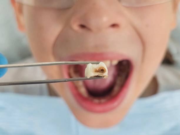 Best Emergency Dentist for Knocked-Out Tooth in Searles Valley, CA